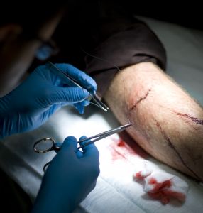 New Surgical Method for Inoperable Pancreatic Cancer? 