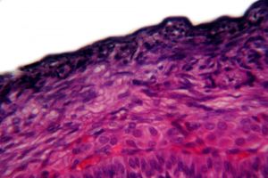 Knowing Options for Skin Cancer Surgery
