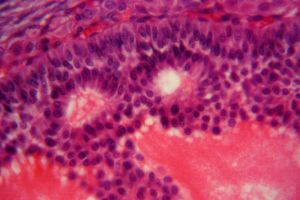 Targeting Leukemia's Kill Switch
