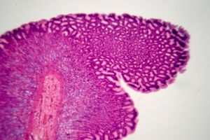 Stomach Cancer Genes Identified