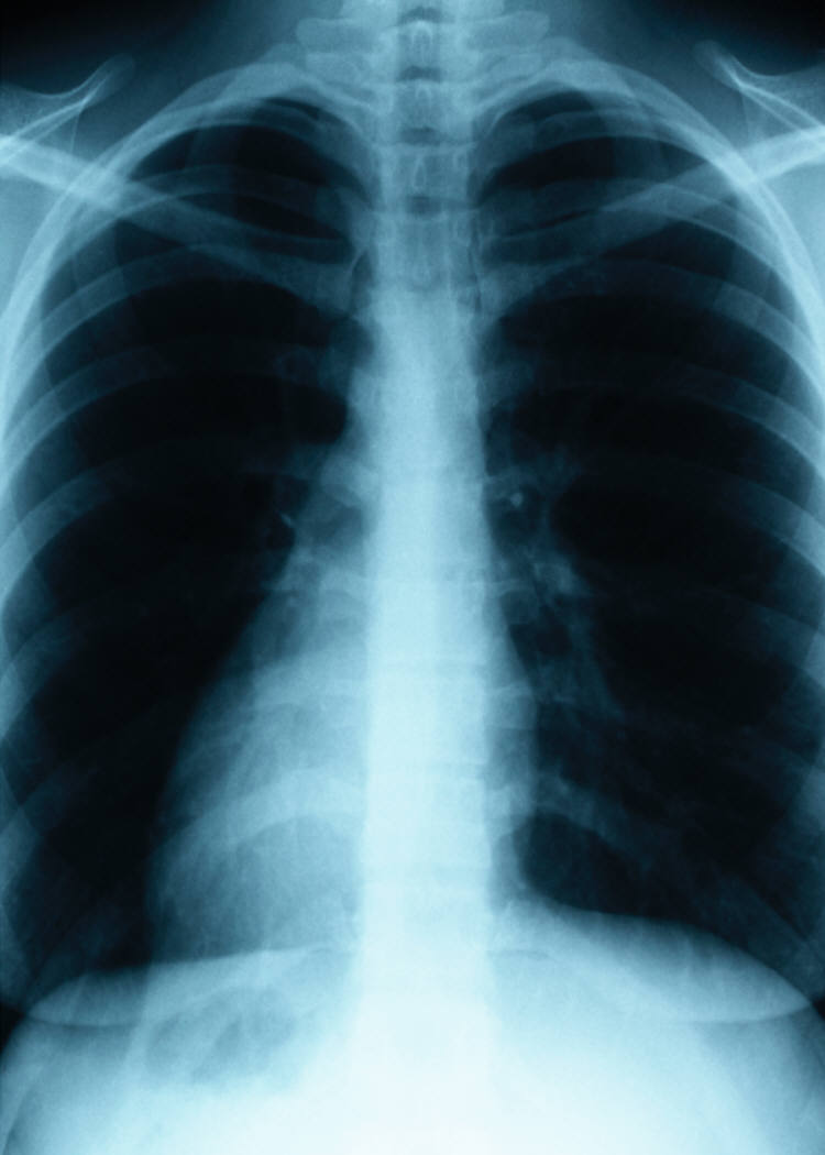 A Medical Mystery Solved