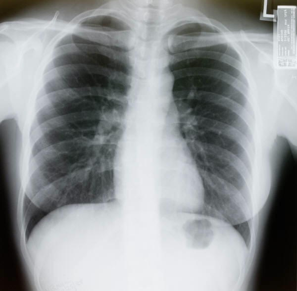 Why Lung Cancer Survival Rates Vary  