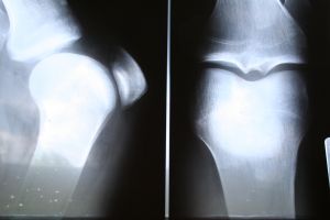 CT Scan For Bone Cancer Triples Accuracy