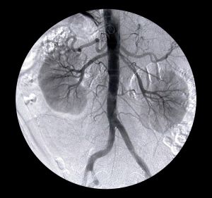 Is Kidney Cancer Rare?