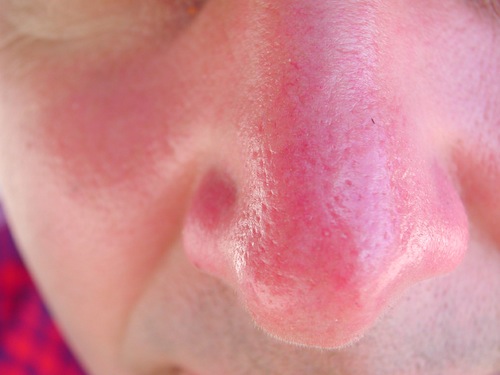 A Cure for Sunburn May be on Horizon