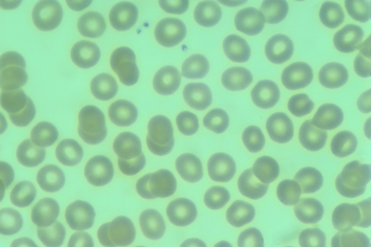 Transplants for Lupus