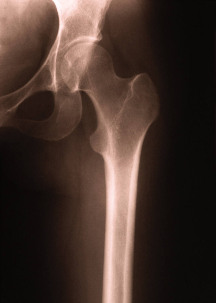 Novel Model for Rheumatoid Arthritis Research