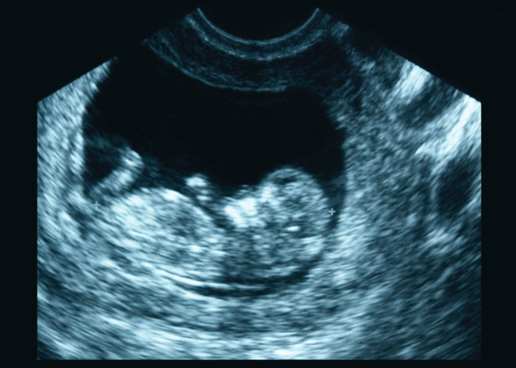 Cystic Fibrosis Growth Defects May Begin Before Birth