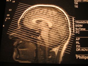 Head & Neck Cancer Aggressive in Transplant Patients