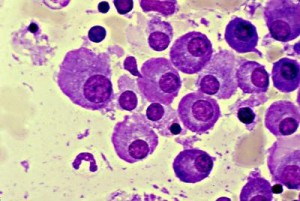 Revlimid and Risk of New Cancers