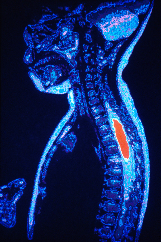 Cancer Therapy May Also Benefit MS Patients