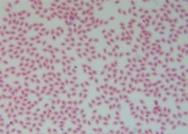 Promising Therapy for Aggressive Blood Cancers