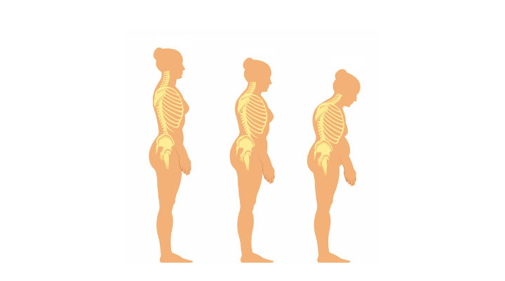 Are You at Risk of Osteoporosis?