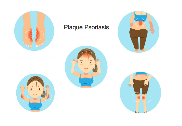 New Psoriasis Rx Gets Green Light