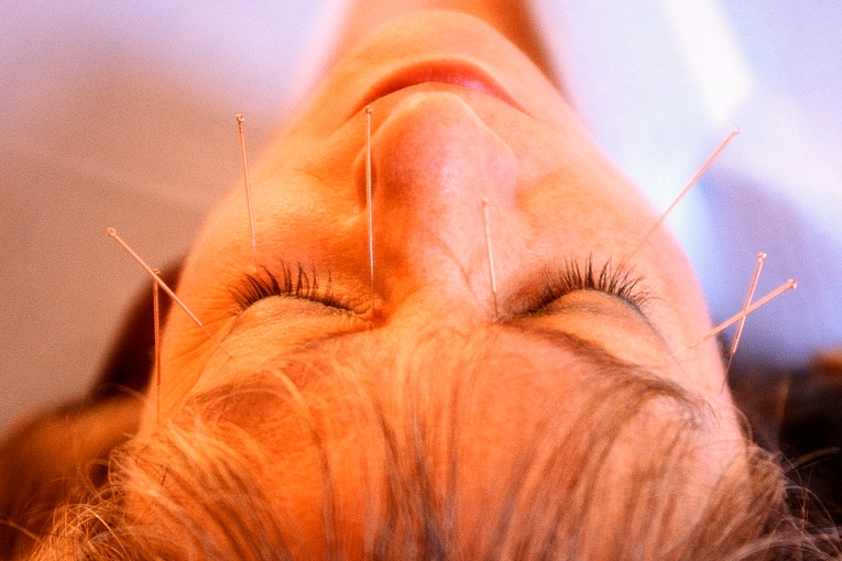 Needles For Bell's Palsy