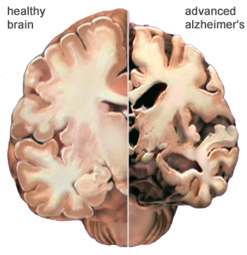 New Drug for Alzheimer's Disease