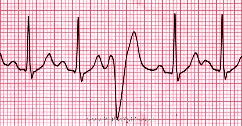 Celexa and Risk of Arrhythmia