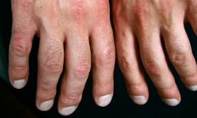 RA Medicines May Increase Skin Cancer Risks