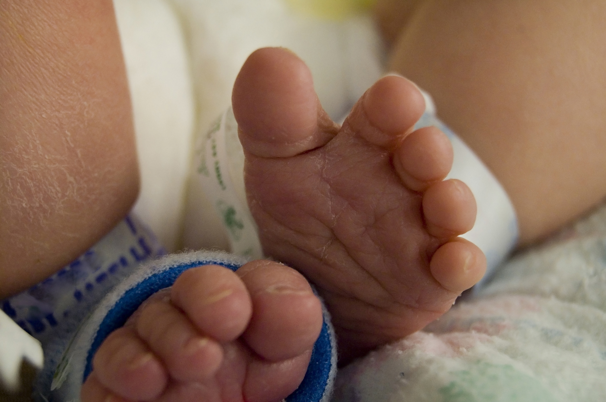 Treating Infant Lung Disease 