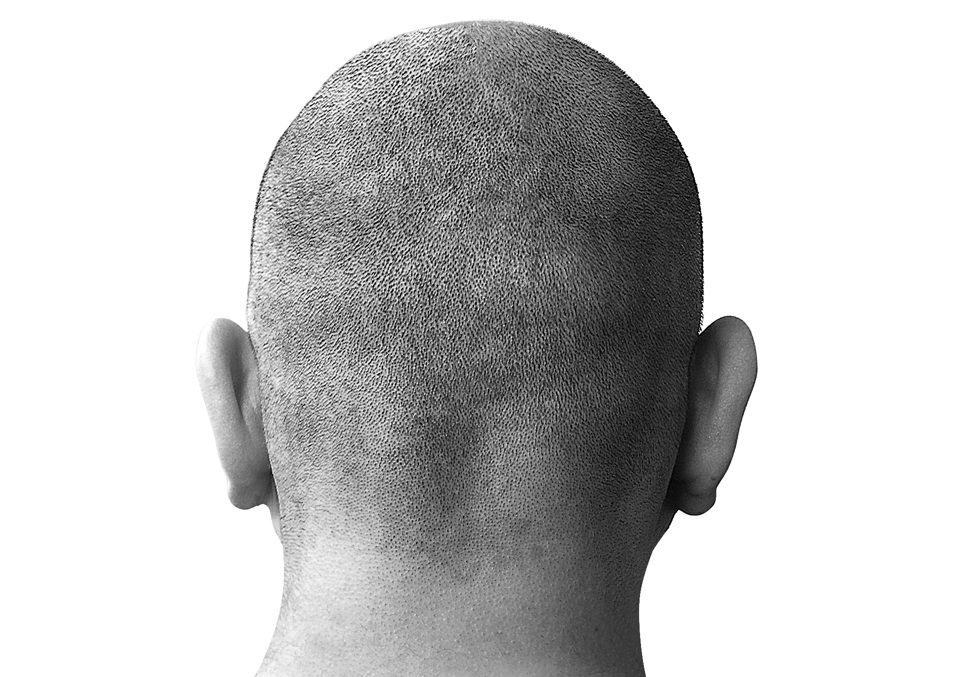 Traumatic Brain Injury Treatment Flops
