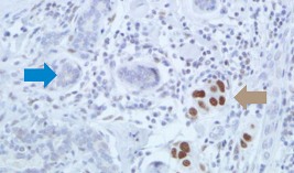 Prognosis Predictor may Become New Target