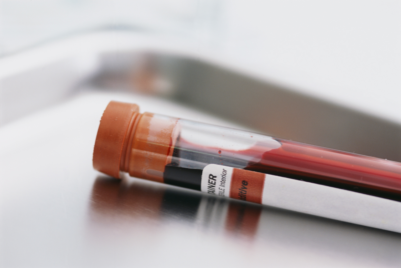 Taking the Guesswork out of Sickle Cell