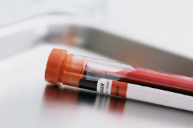 Ovarian Cancer in Pelvic Masses