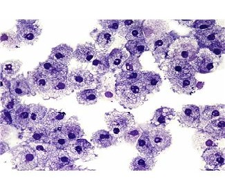 Protecting HIV Patients From Tuberculosis