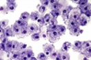 "Turned Off" in Human Tumors