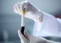 New Test Detects Prostate Cancer More Accurately