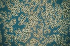 New Drugs Could Treat Half of Prostate Cancers