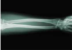 Protecting Your Bones May Hurt Your Heart