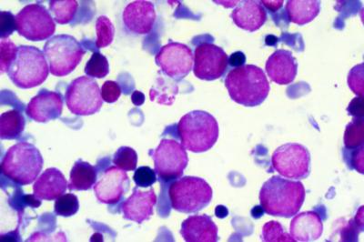 Inherited Leukemia Gene Discovered