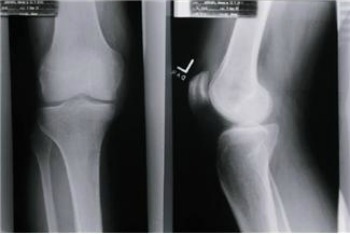 Get healthy on World Osteoporosis Day
