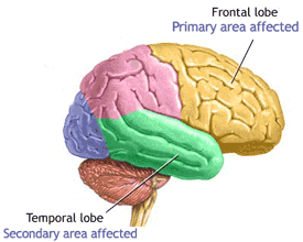 Clinical Endpoints Not Met In Alzheimer Drug Study
