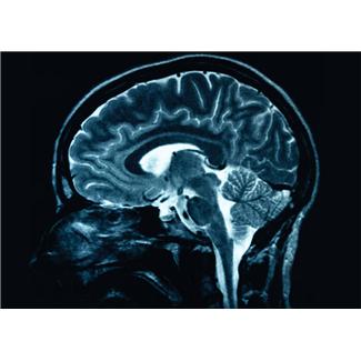 MS and Gray Matter