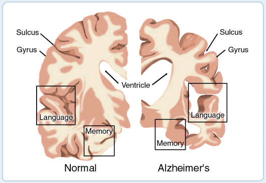 Pfizer Announces Alzheimer’s Disease Study Results