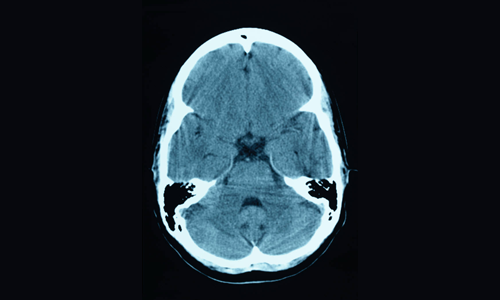 Use of Stroke Clot Busters Up