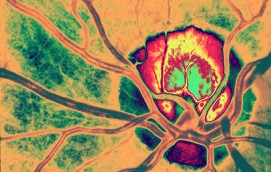 Stopping Breast Cancer in its Tracks