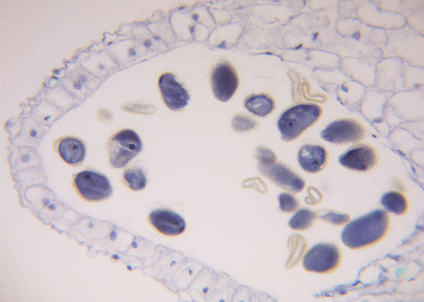 Finding a Pathway to Battle Pancreatic Cancer