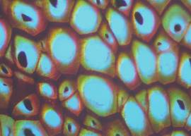 Stomaching Acid Reflux's Link to Cancer