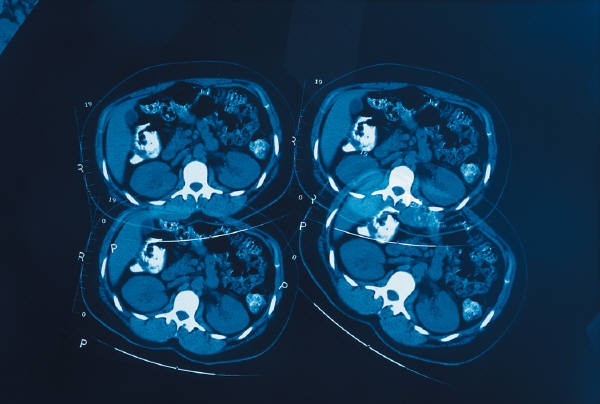 Brain Function Changes Identified in Early HIV