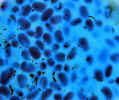 New Cancer Treatment Given the "Blue"-light