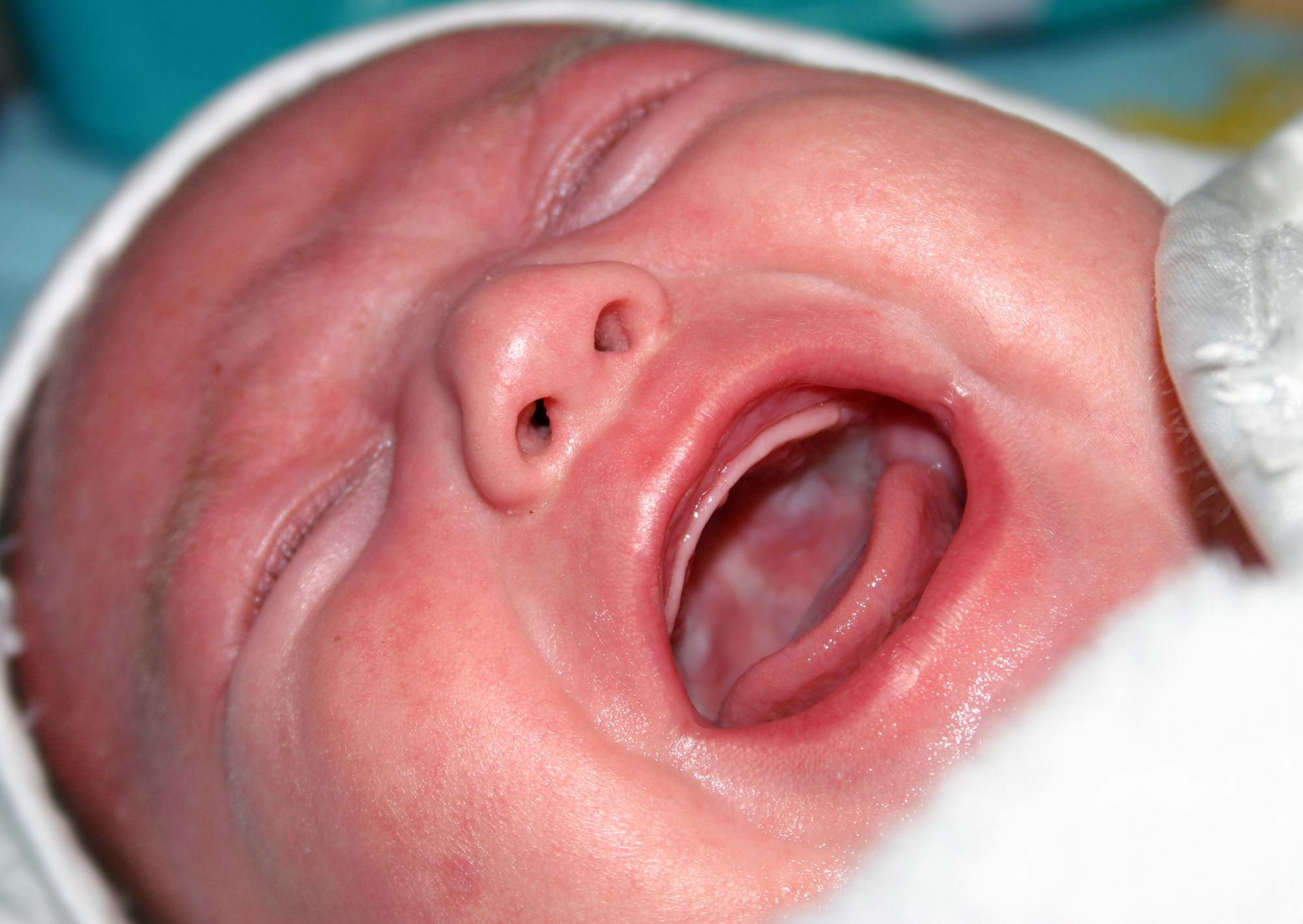 Mom's Double Whammy: Migraines and Colic