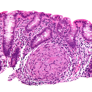 Combination Therapy for Crohn's Disease