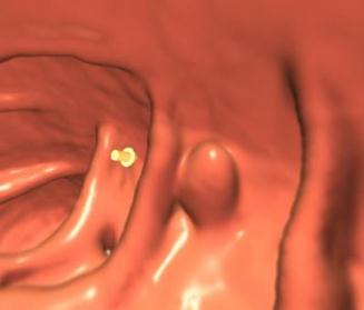 Electronically Cleansed Colon Screening