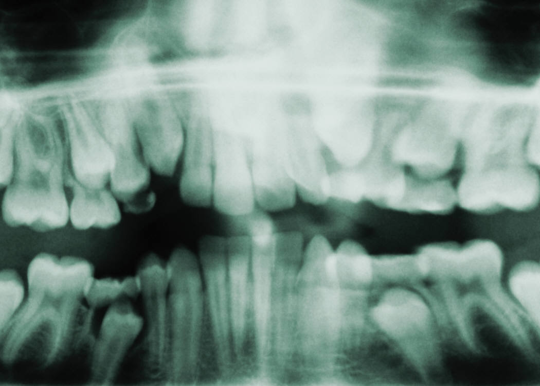 From Mouth to Back: Gum Disease and AS