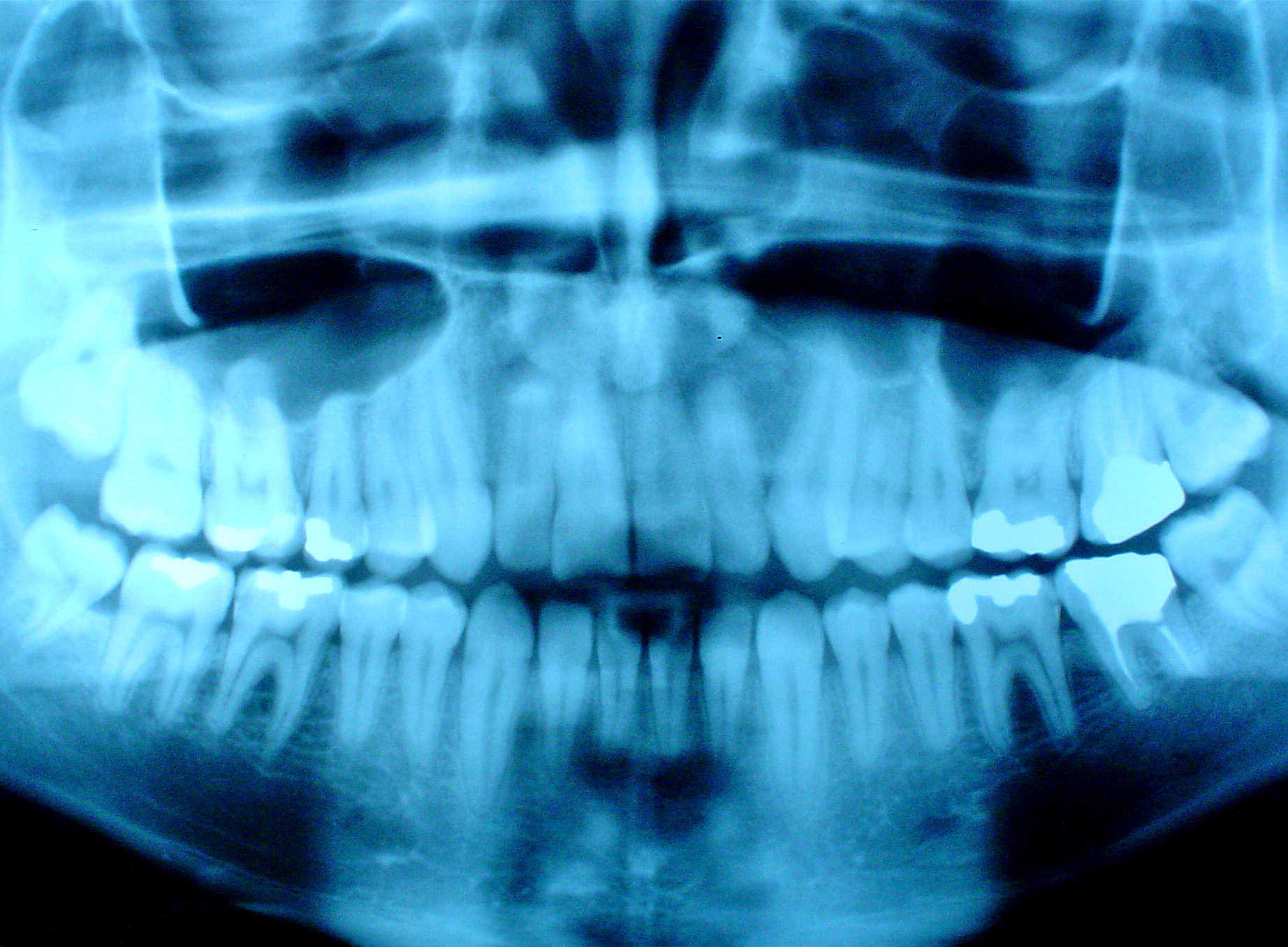 Jaw Dropping Cancer Therapy Side Effects