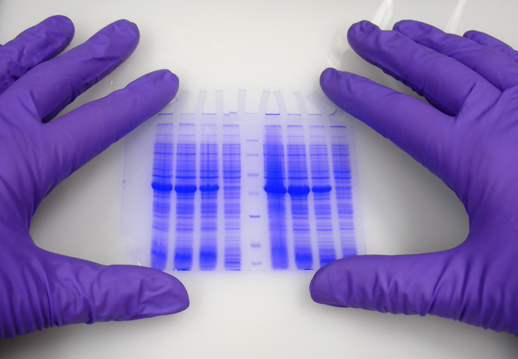 Gene Points to Donated Kidney Rejection