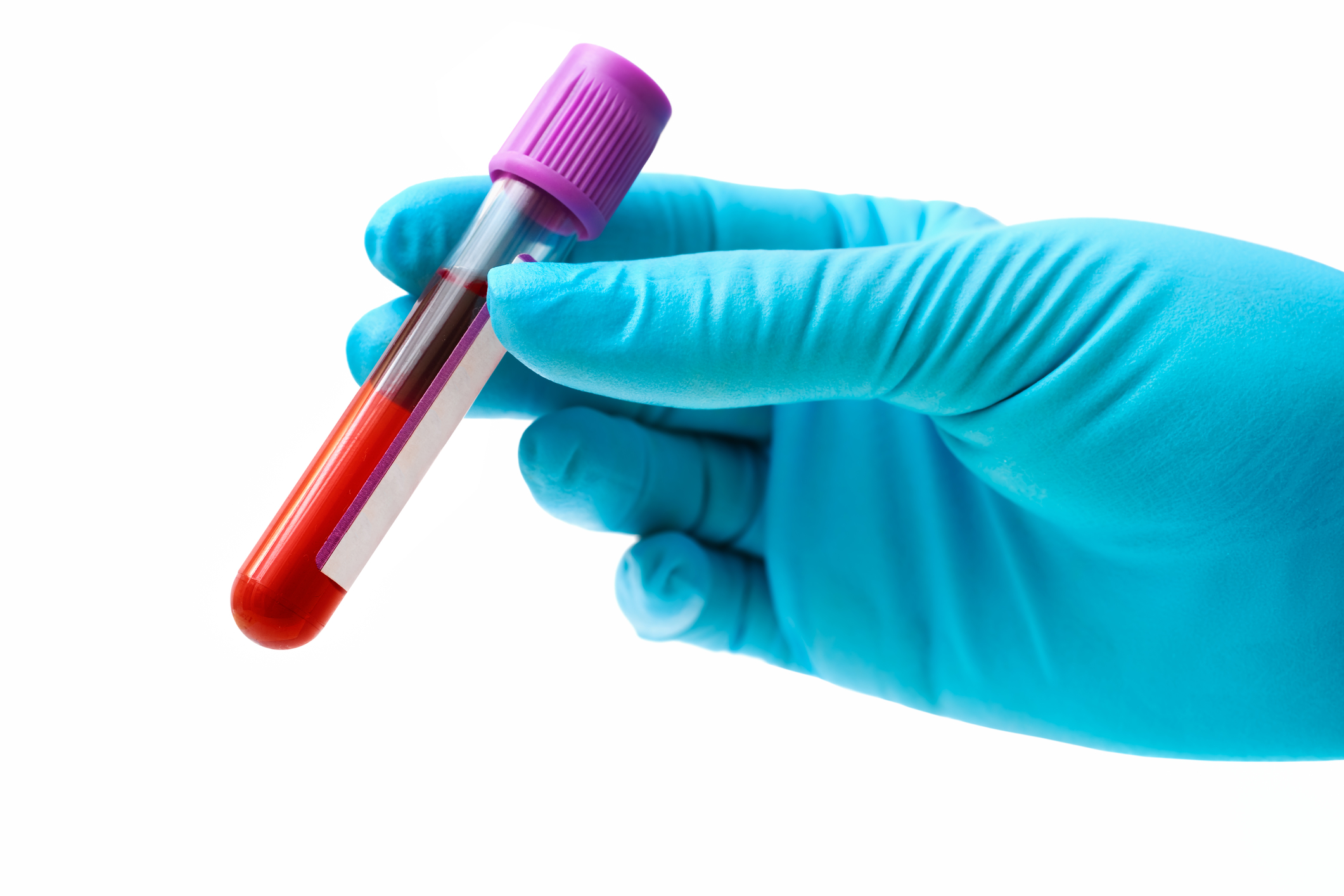 New Test May Spot Breast Cancer Treatment Resistance